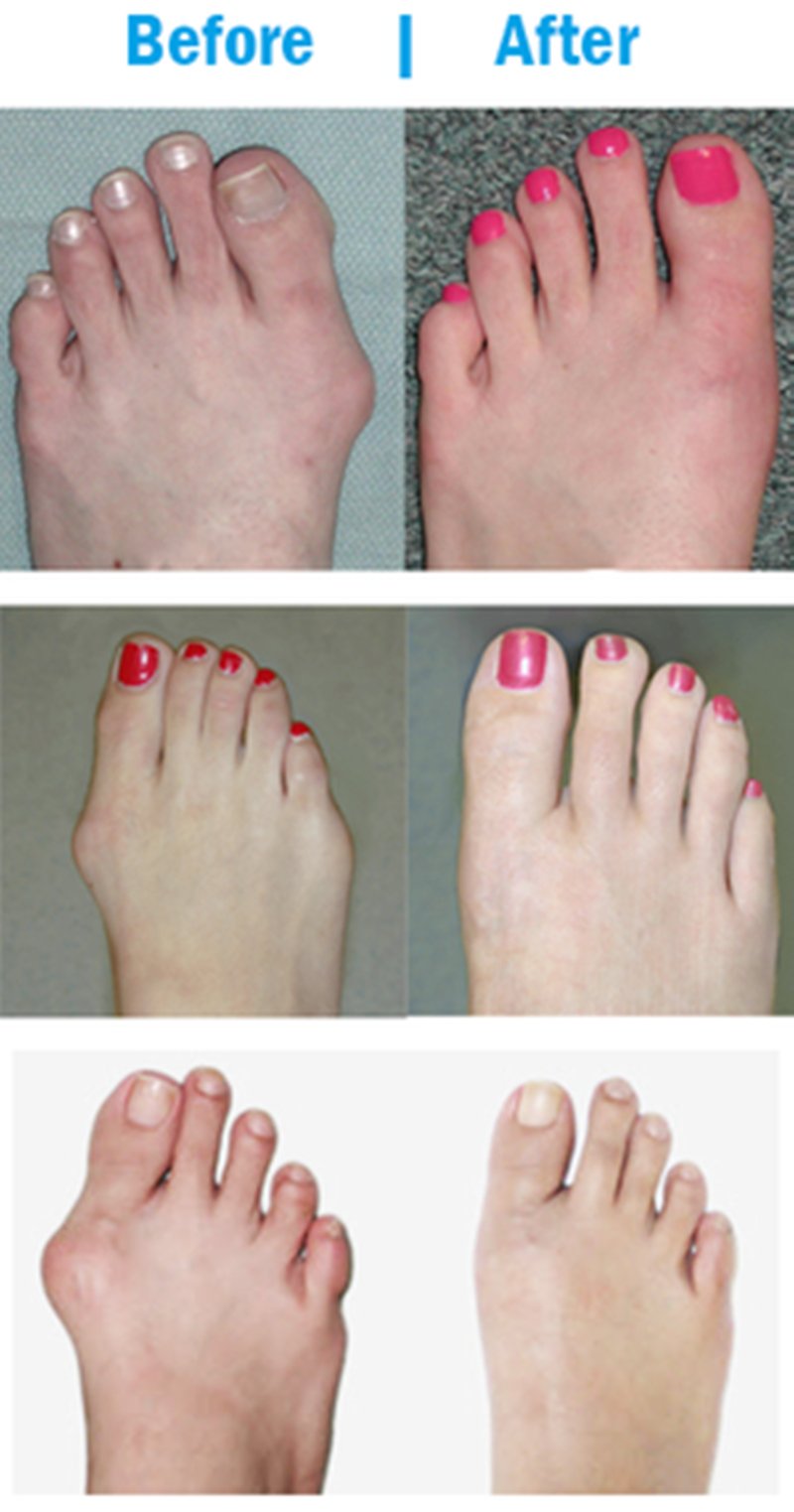 Elastic Bunion Corrector