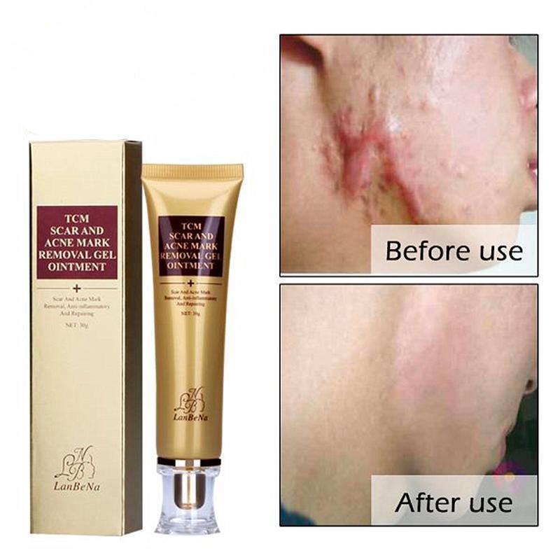 Acne Scar Remover Cream